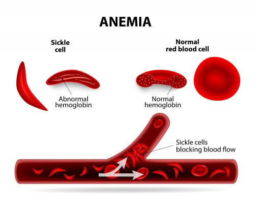 anemia