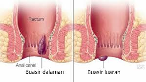 buasir