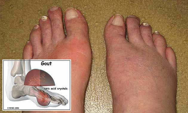 tanda tanda gout di kaki