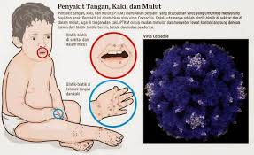 Penyakit Tangan Kaki dan Mulut