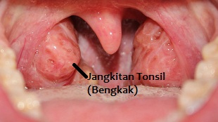 tonsil