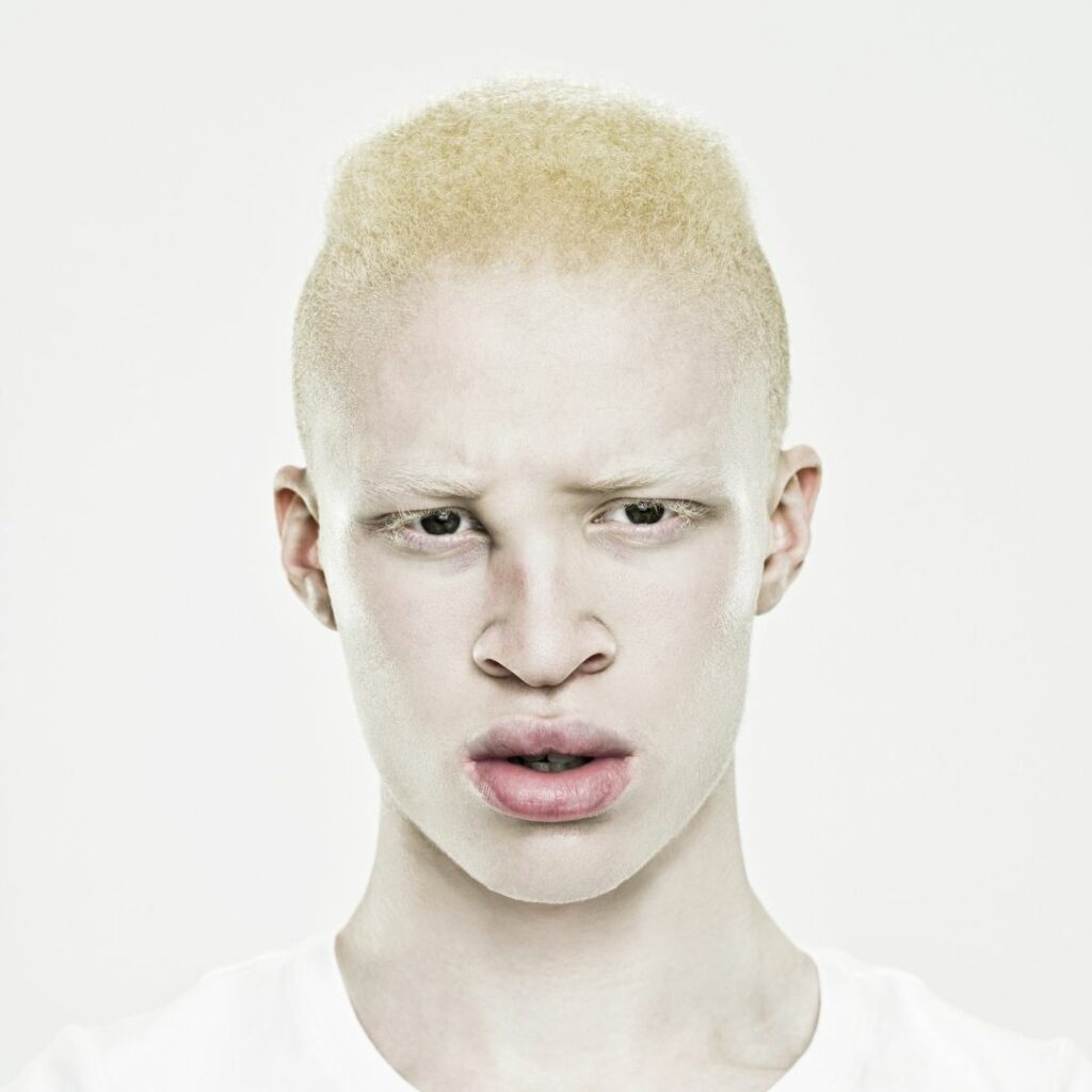 негр и азиат альбинос фото 74