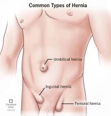 Hernia - Gejala, Punca dan Rawatan 1 hernia