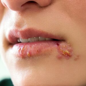 herpes