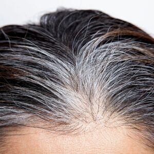 Poliosis - Gejala, Punca dan Rawatan 1 poliosis