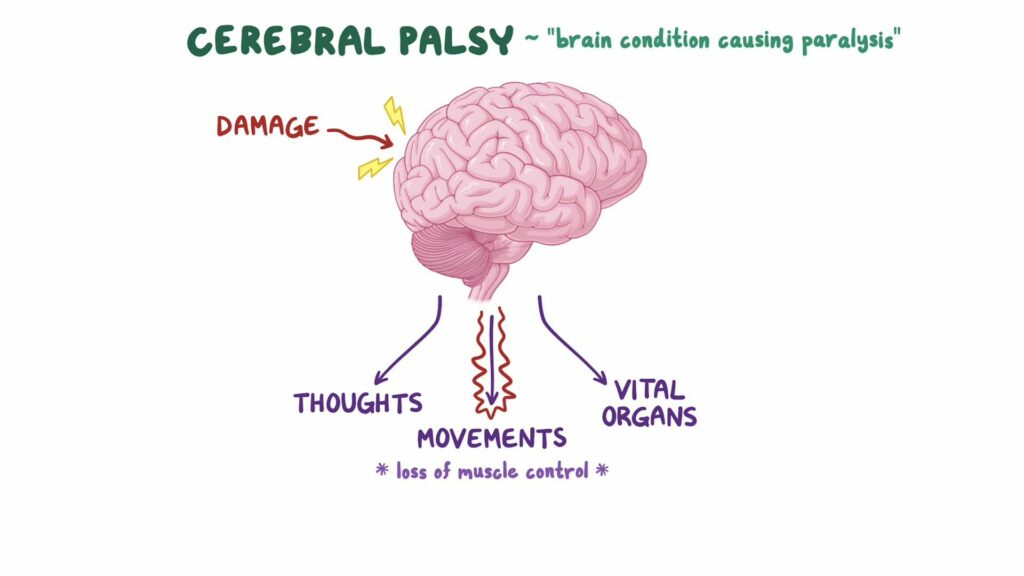 4 Jenis Cerebral Palsy: Simptom, Kesan & Rawatan 1