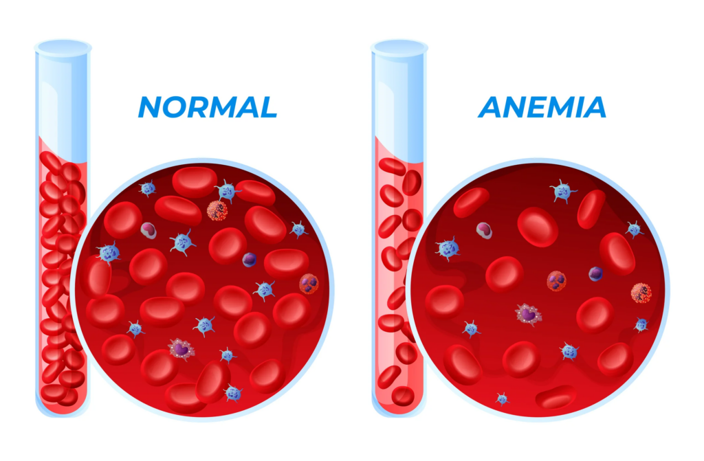 Anaemia: 4 Cara Atasi Pada Ibu Hamil 1