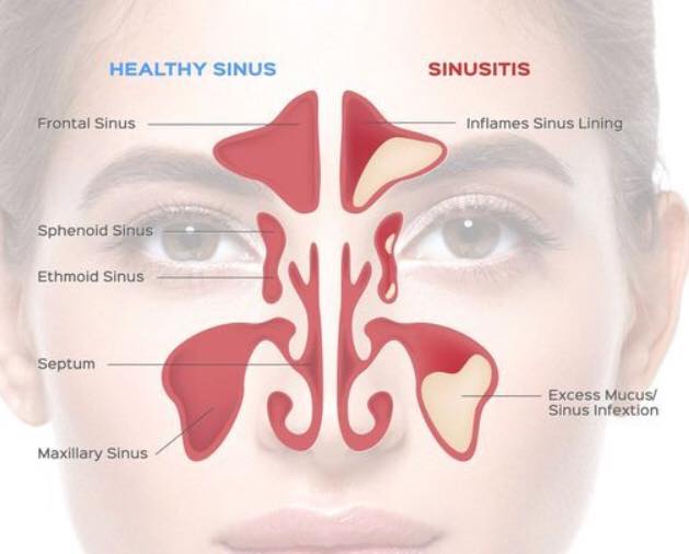 Sinus: Terdapat 4 Tahap Yang Perlu Diawasi 1