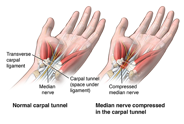 Carpal Tunnel Syndrome: Simptom, Punca, Risiko & Rawatan 1