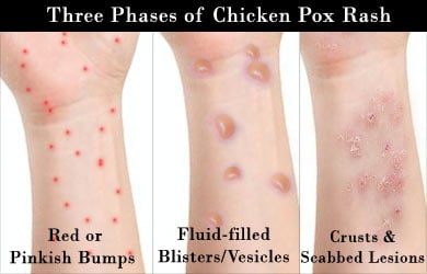 3 Fasa Chicken Pox: Simptom, Punca, Risiko, Komplikasi & Rawatan 6