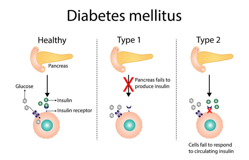 Diabetes Mellitus: Simptom, Punca, Risiko & Rawatan Pencegahan 1