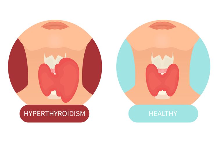 Hipertiroid: Simptom, Punca, Risiko & Rawatan Pencegahan 1