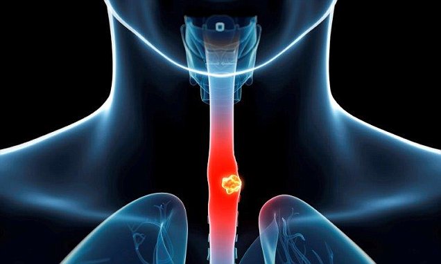 Dysphagia: Simptom, Punca, Komplikasi, Diagnosis & Rawatan 1 Dysphagia: Simptom, Punca, Komplikasi, Diagnosis & Rawatan 1