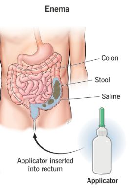 Enema: Fungsi, Jenis, Cara Penggunaan & Kesan Sampingan 1 Enema: Fungsi, Jenis, Cara Penggunaan & Kesan Sampingan 1