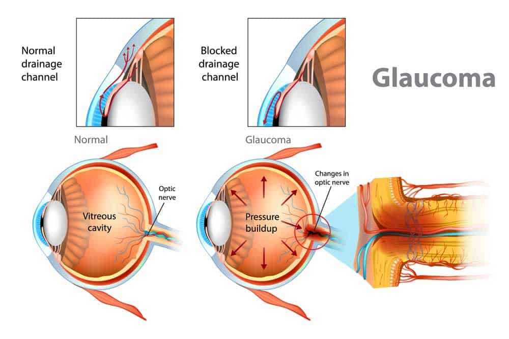 Glaukoma: Jenis, Punca, Faktor Risiko, Simptom & Komplikasi 2 Glaukoma: Jenis, Punca, Faktor Risiko, Simptom & Komplikasi 2