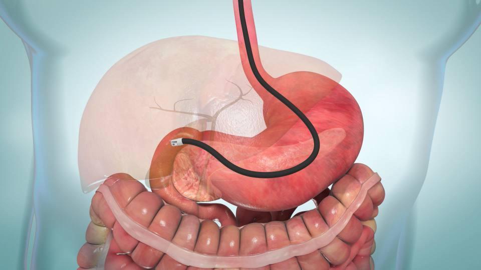 ERCP: Fungsi, Prosedur & Potensi Risiko / Komplikasi 1 ERCP: Fungsi, Prosedur & Potensi Risiko / Komplikasi 1